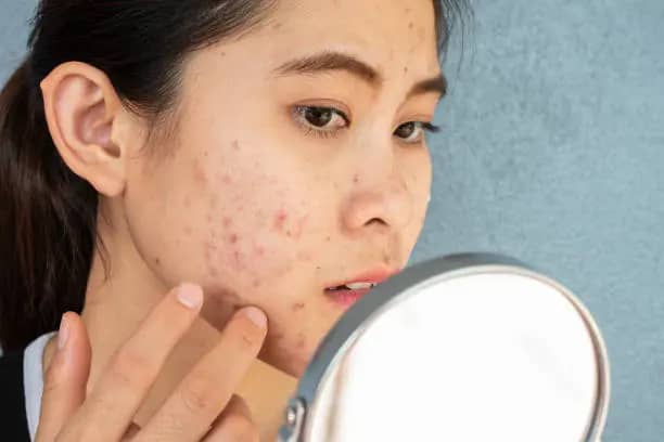 how to stop getting black heads